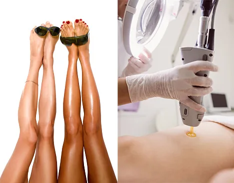 Épilation laser du visage et du corps