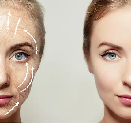 Fils tenseurs pour redessiner l'ovale du visage